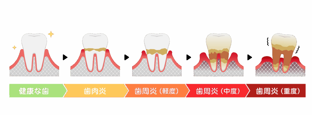 歯周病の進行｜やくし歯科